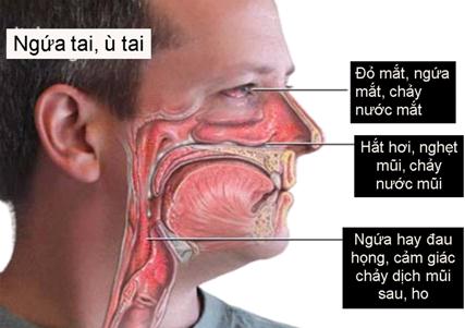 Các triệu chứng của viêm mũi dị ứng. (Ảnh minh họa)