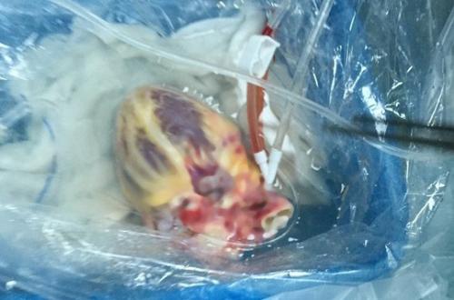 Quả tim sau khi phẫu thuật lập tức được bảo quản trong dung dịch đặc biệt và cho vào một túi nilon sau đó bỏ vào thùng đá. 