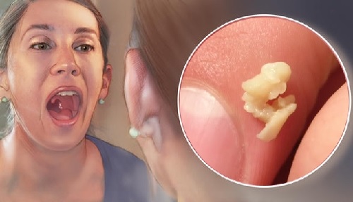 Viêm Amidan là nguyên nhân gây hôi miệng khá phổ biến

