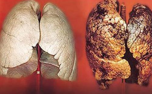 Phổi bình thường và phổi bị hư do ung thư