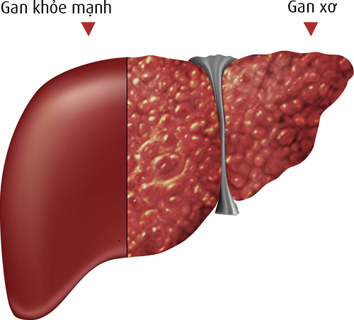 Xơ gan là một nguyên nhân phổ biến gây tràn dịch màng phổi