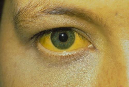 Vàng mắt là một trong những triệu chứng của viêm gan B