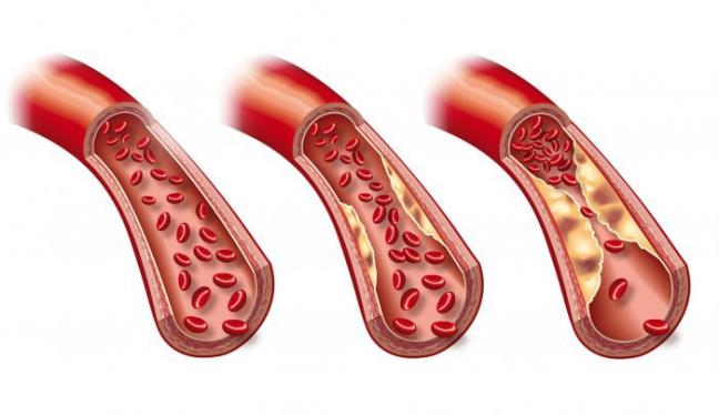 Dieu tri tang triglyceride mau