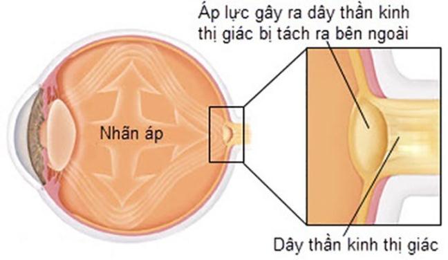 Cac benh ly ve mat thuong gap