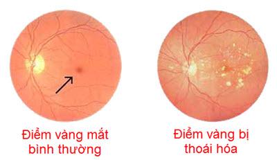 Cac benh ly ve mat thuong gap