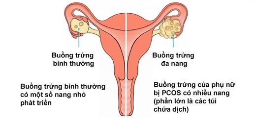 Hoi chung buong trung da nang- nguyen nhan pho bien gay hiem muon o phu nu