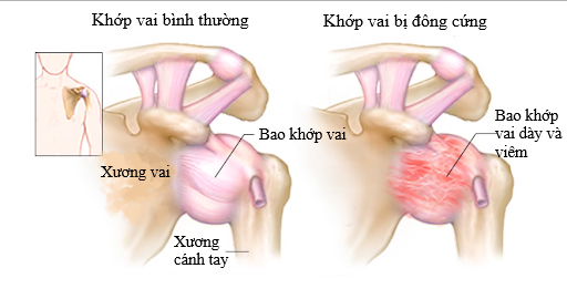 Viem khop vai the dong cung: can benh pho bien nhung it nguoi biet