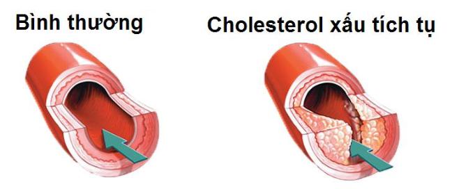 Chi so cholesterol xau tang cao de mac benh tim, an gi de kiem soat?