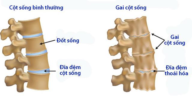 Che do dinh duong hop ly cho nguoi bi gai cot song