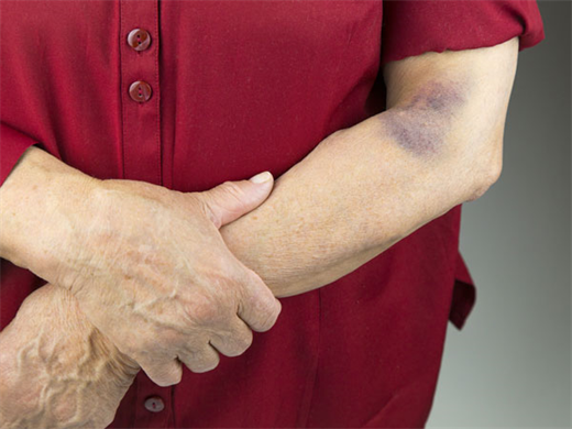 Vet bam tim dot nhien xuat hien tren da canh bao dau hieu suc khoe dang lo ngai