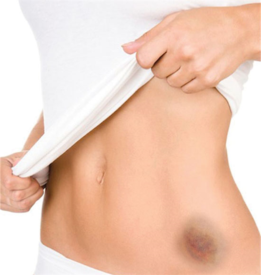 Vet bam tim dot nhien xuat hien tren da canh bao dau hieu suc khoe dang lo ngai