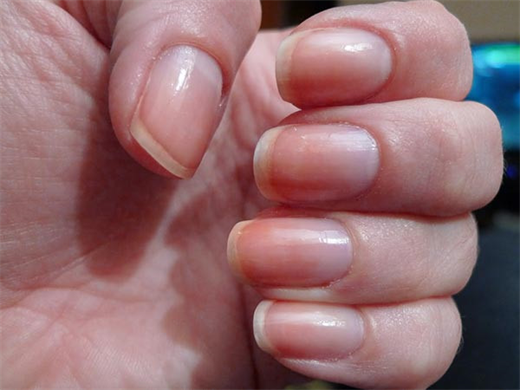 10 dấu hiệu bất thường ở móng tay cảnh báo tình trạng sức khỏe của bạn 10 dấu hiệu bất thường ở móng tay cảnh báo tình trạng sức khỏe của bạn