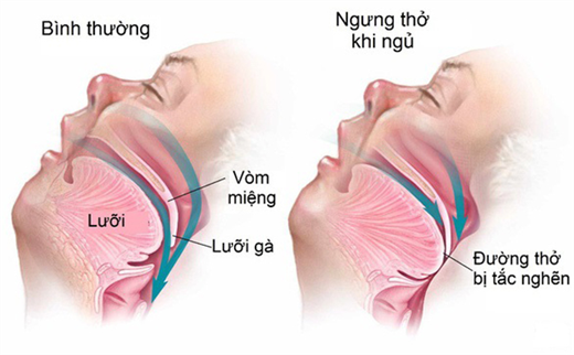 90% nguoi khong biet nhung can benh nguy hiem an nap dang sau viec chay nuoc dai khi ngu