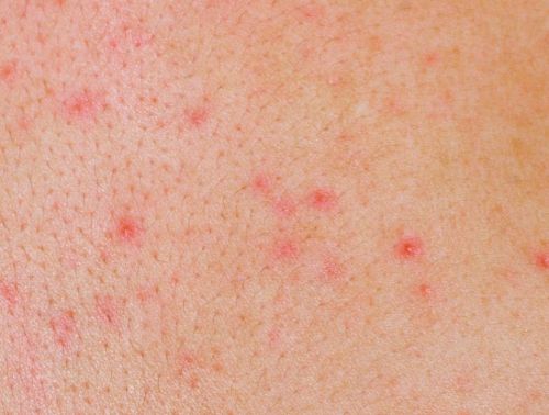 MC Dieu Linh bi ung thu mau, can benh nay co nguyen nhan va trieu chung ra sao?