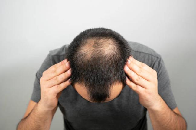 Làm thế nào để khắc phục rụng tóc khi gội đầu ở nam giới