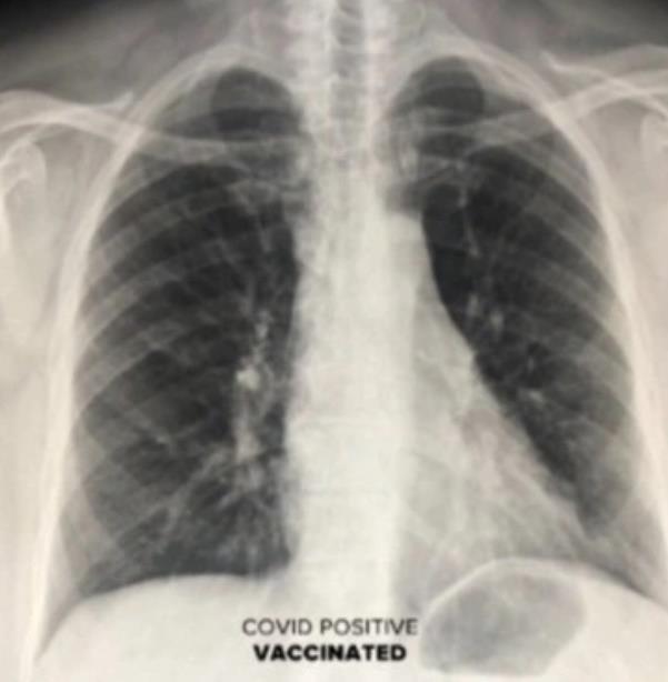 Chup X-quang cho thay su khac biet dang kinh ngac ma vaccine COVID-19 thuc su tao ra