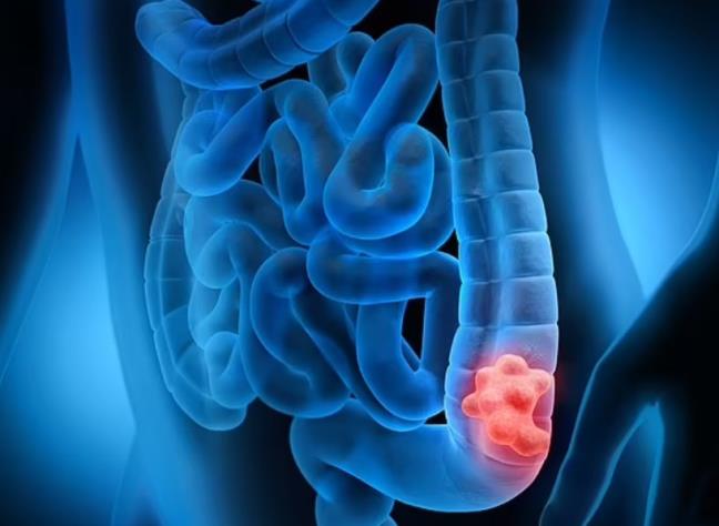 Thu nghiem thuoc chua ung thu tren 18 nguoi, 100% khoi benh, du di can o giai doan 2 va 3