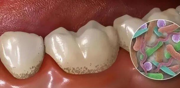 Lay cao rang co lam ton thuong rang khong? 5 nhom nguoi nay khong nen lay cao rang