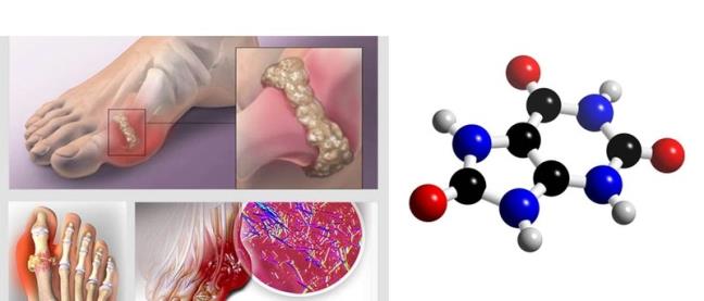 Axit uric la gi va no anh huong den co the ban nhu the nao?