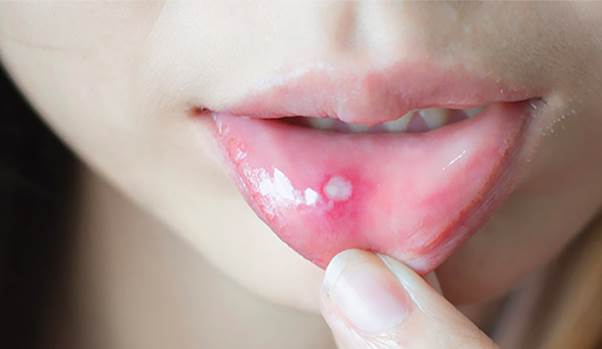 5 cach giup ban tam biet ngay tinh trang nhiet mieng