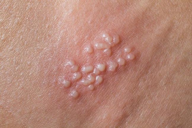 Khi nam gioi bi nhiem HPV, ho thuong co hai trieu chung! 4 kieu dan ong ban nen tranh xa