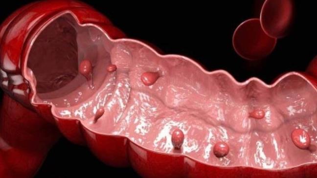 Polyp dai trang rat kho phat hien, thay doi nhung thoi quen nay chung se khong tim den ban