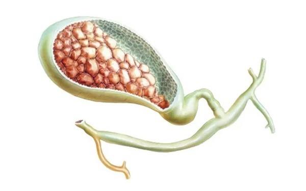 Cac bac si&nbsp;tiet lo&nbsp;nhung nguoi mac benh tui mat thuong co 3 trieu chung sau