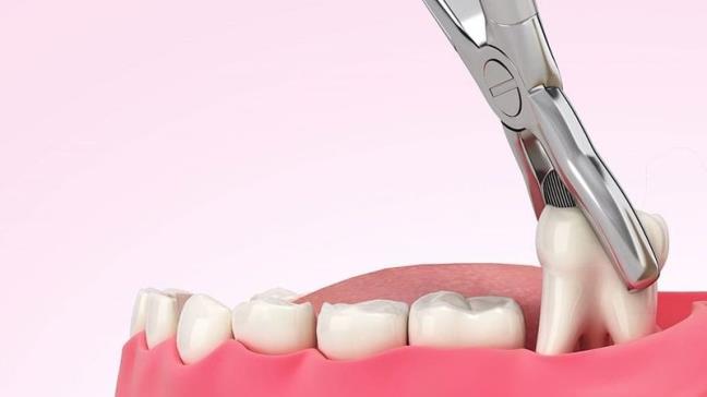 Quy trinh nho rang khon dien ra nhu the nao? Hay lam dieu sau de vet thuong mau lanh hon sau phau thuat