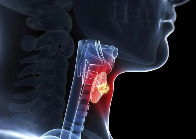 Nhung nguyen nhan gay ung thu tuyen giap va cach phong ngua