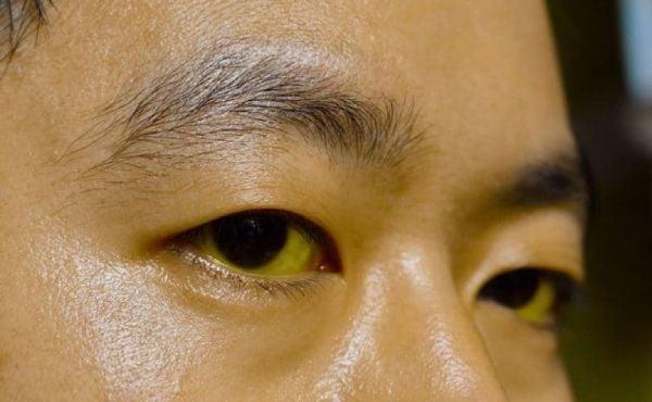 Neu co 3 bat thuong ve mat nay, hay di kiem tra gan ngay lap tuc