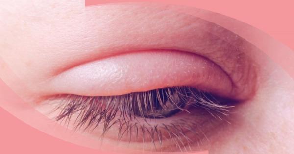 Neu mi mat cua ban luon sung nhu the nay vao buoi sang, hay di kham than ngay