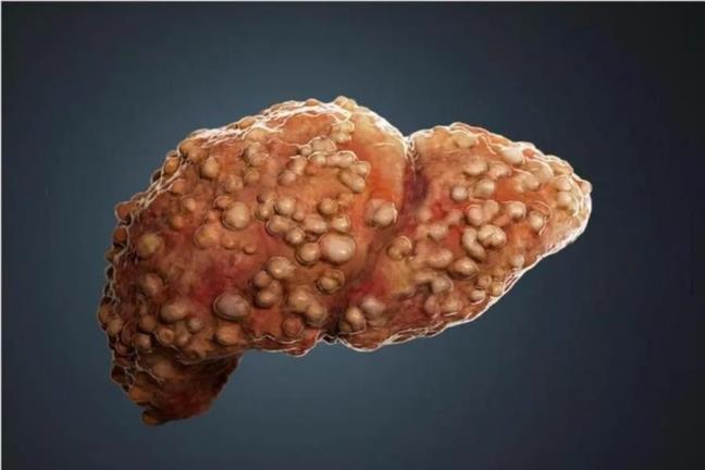 Dieu chinh thu tu an uong co the dao nguoc gan nhiem mo, hieu qua tuong duong dieu tri bang thuoc