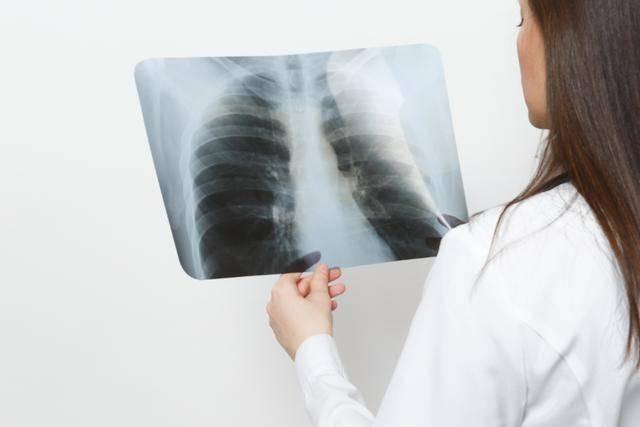 ‘Voi hoa’ thuong duoc phat hien trong cac bao cao kham benh, nhung loai voi hoa nao dang lo ngai?