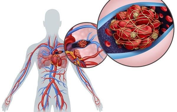 Thuyen tac phoi co the nguy hiem hon ca nhoi mau co tim, 4 nhom nguoi de mac benh 