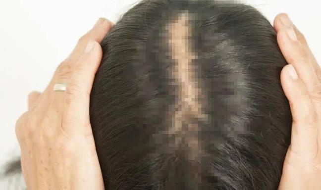 Nam gioi co chuc nang than kem thuong bieu hien ba trieu chung o vung dau, hay xem ban co khong?