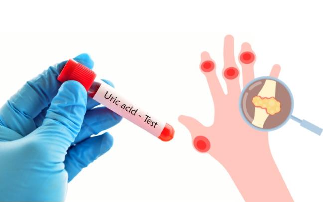 Loai trai cay lam tang nong do axit uric nhanh nhat da duoc xac dinh, nhung nguoi co nguy co nen tranh