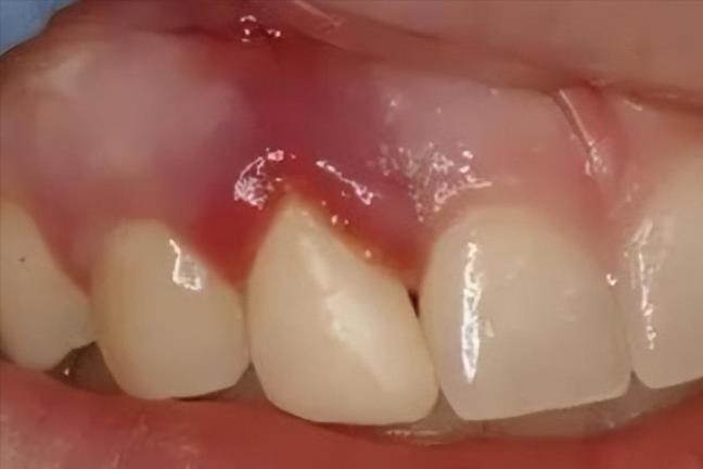 Tac hai nghiem trong cua viec chai rang theo chieu ngang 