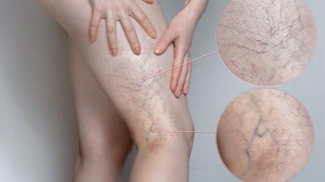 Chung gian tinh mach khong tu nhien xuat hien, chu yeu la do 4 nguyen nhan nay