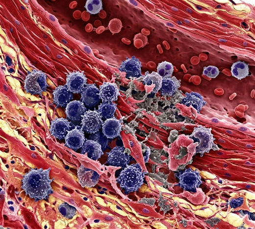 5 trieu chung cua viem co tim nhung bi nham voi cam cum, nguy co gay dot quy cao