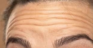 Khuon mat xuat hien 3 loai nep nhan nay, co the la dau hieu cua tac nghen tim mach