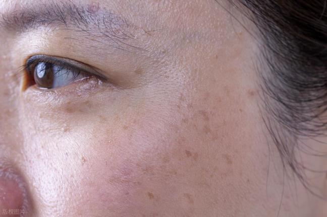 Khong muon lang phi thoi gian va cong suc&nbsp;de xoa tan nhang, tim hieu ngay 4 phuong phap khoa hoc va 3 quan niem sai lam pho bien