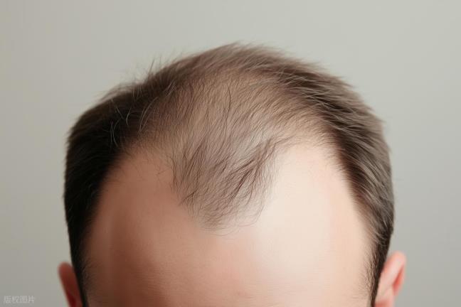 Toc thua khong chi la dau hieu cua tuoi gia, nhung thoi quen xau nay dang cuop di mai toc cua ban