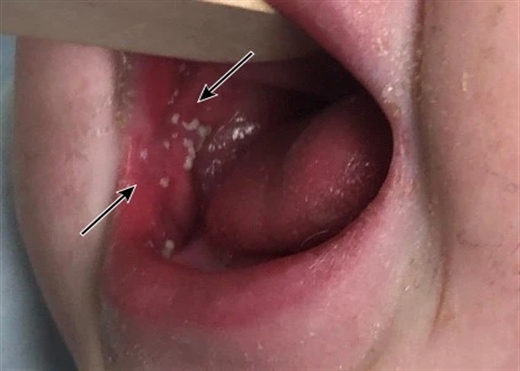 Sot phat ban hay soi? 3 dau hieu phan biet 