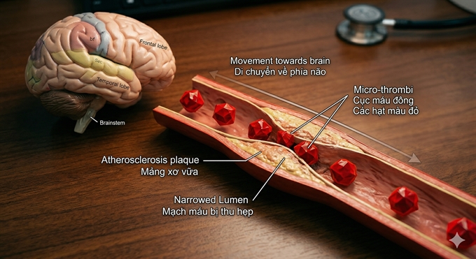 4 chi so xet nghiem mau giup bao hieu nguy co dot quy, nhung lai thuong bi bo qua