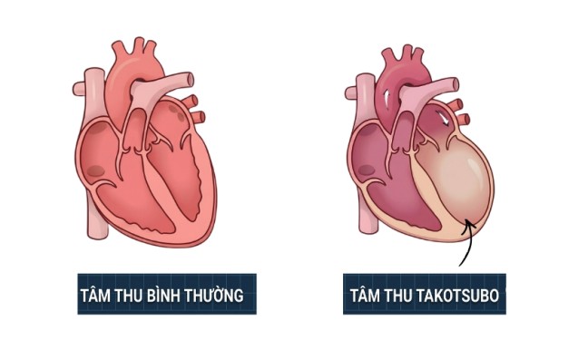 Vi sao hoi chung trai tim tan vo lai 