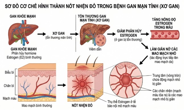 Canh bao nguy co xo gan tiem an khi co the xuat hien nhieu not nhen do!