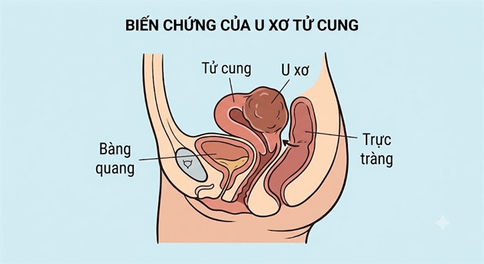 U xo tu cung co the gay bien chung nguy hiem, khi nao can theo doi hoac can thiep?