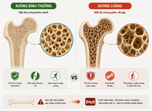 Loãng xương không đợi tuổi già: 3 nhóm người nên tầm soát sớm Loang xuong khong doi tuoi gia: 3 nhom nguoi nen tam soat som