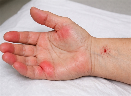 Cách nhận biết men gan cao qua những thay đổi nhỏ trên làn da và hơi thở Cach nhan biet men gan cao qua nhung thay doi nho tren lan da va hoi tho